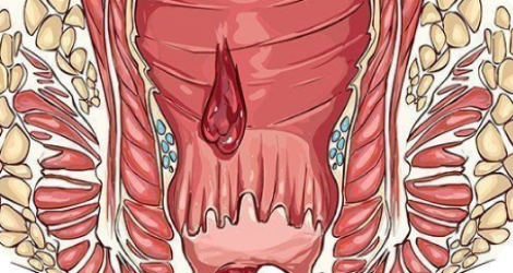  СИМПТОМЫ ПРИ ГЕМОРРОИДАЛЬНЫХ УЗЛАХ