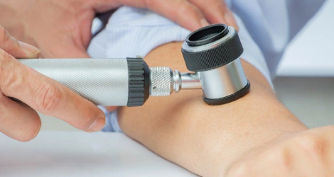  СИМПТОМЫ ПРИ ЛИШАЕ