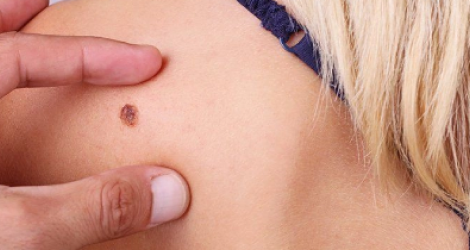  СИМПТОМЫ ПРИ НОВООБРАЗОВАНИЯХ КОЖИ: