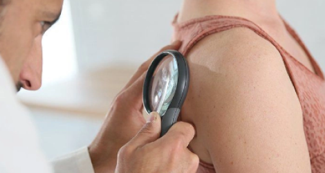  СИМПТОМЫ ПРИ ПСОРИАЗЕ: